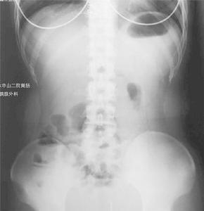 克罗恩病 克罗恩病