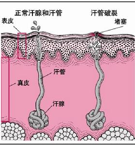多汗症 多汗症