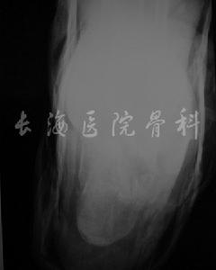 跟骨骨折