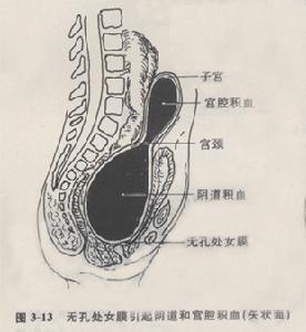 闭经 闭经