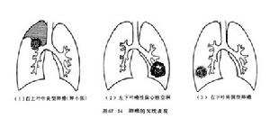 支气管肺癌 支气管肺癌