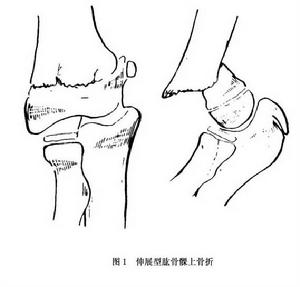 肱骨髁上骨折 肱骨髁上骨折