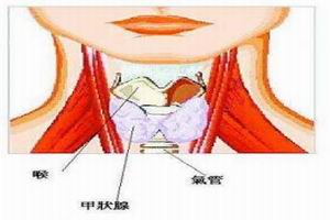 甲状腺癌 甲状腺癌