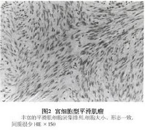 富细胞型平滑肌瘤 富细胞型平滑肌瘤