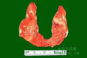 甲状腺癌 甲状腺癌