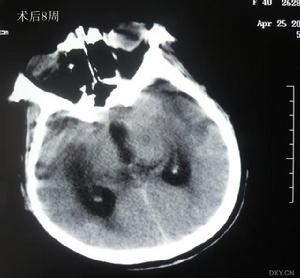 腔隙性脑梗死