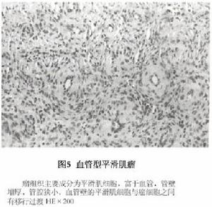 血管型平滑肌瘤 血管型平滑肌瘤