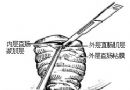 直肠脱垂