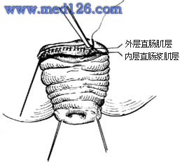 直肠脱垂 直肠脱垂