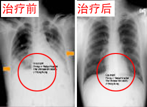 胸壁结核 胸壁结核