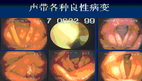 声带息肉