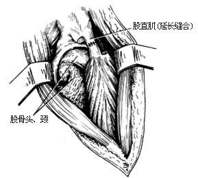 髋关节结核 髋关节结核