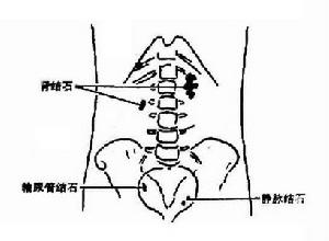 肾结石 肾结石