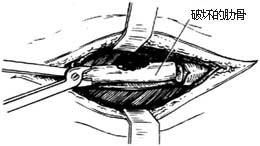 胸壁结核 胸壁结核