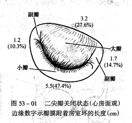风湿性二尖瓣狭窄