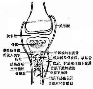 急性血源性骨髓炎 急性血源性骨髓炎