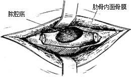 胸壁结核 胸壁结核