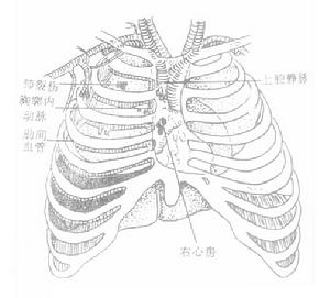 血胸 血胸