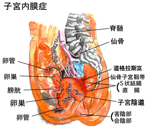慢性子宫内膜炎 慢性子宫内膜炎