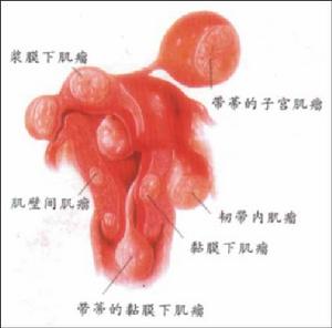 子宫肌瘤 子宫肌瘤