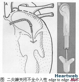 风湿性二尖瓣狭窄
