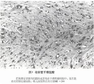 奇异型平滑肌瘤或称非典型平滑肌瘤 奇异型平滑肌瘤或称非典型平滑肌瘤