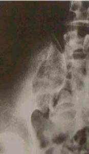 骶髂关节结核 骶髂关节结核