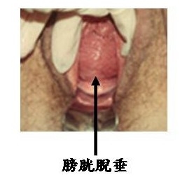 直肠脱垂 直肠脱垂
