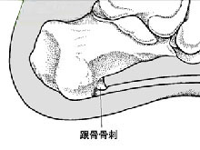 跟骨骨刺 跟骨骨刺