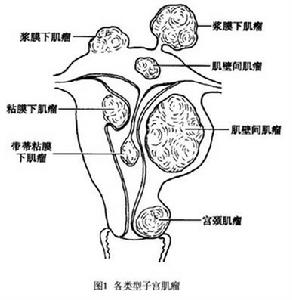 子宫肌瘤 子宫肌瘤