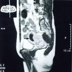 慢性盆腔炎 慢性盆腔炎