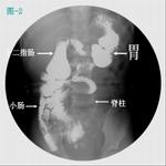 先天性巨结肠症