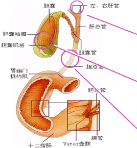 胆总管结石