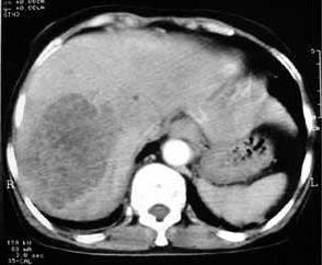 腔隙性脑梗死