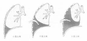血胸 血胸