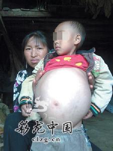 先天性巨结肠症