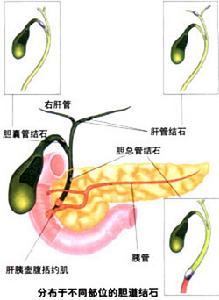 急性胆囊炎 急性胆囊炎