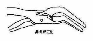 鼻骨骨折 鼻骨骨折