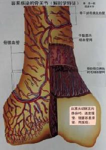 (图)慢性血源性骨髓炎 (图)慢性血源性骨髓炎