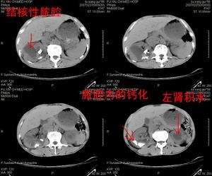 肾结核对侧肾积水