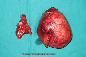 甲状腺癌 甲状腺癌