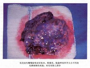 恶性葡萄胎 恶性葡萄胎