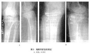 (图)胫骨平台骨折 (图)胫骨平台骨折