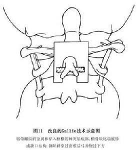 （图）单纯性寰枢椎脱位