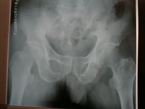 髋关节结核 髋关节结核