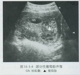 恶性葡萄胎 恶性葡萄胎