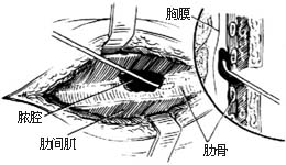 胸壁结核 胸壁结核