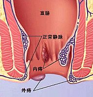 肛门瘙痒 肛门瘙痒