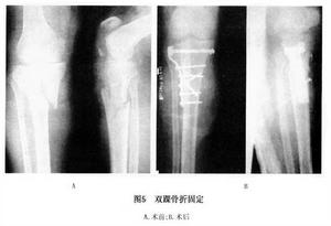 (图)胫骨平台骨折 (图)胫骨平台骨折