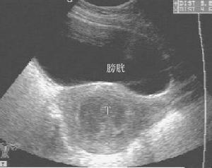 子宫肌瘤 子宫肌瘤